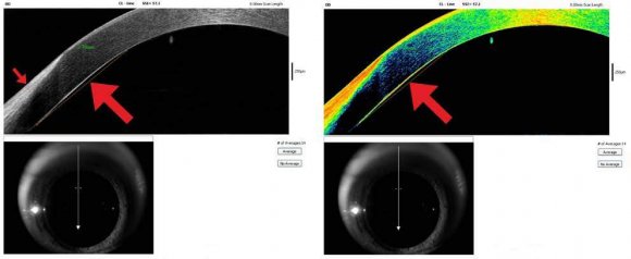 Fig. No. 3: Comparison graph for RMS in normal (Bubbled line) and ALS patients (Plain line)