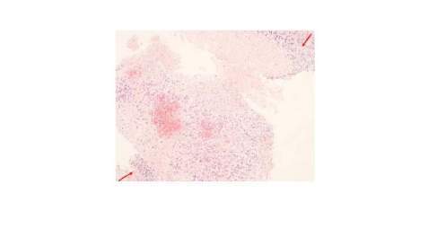 10 patients additionally received 6 cycles of intraventricular chemotherapy. No recurrence was observed in the Volume XVII Issue II Version I © 2017 Global Journals Inc. (US) Characteristics and Outcomes of Patients with Primary Central Nervous System Lymphoma study population. Toxicities included pancytopenia, infection, mucositis and neurotoxicity. 3 patients died as a result of sepsis due to severe neutropenia. Outcomes are summarized in Table