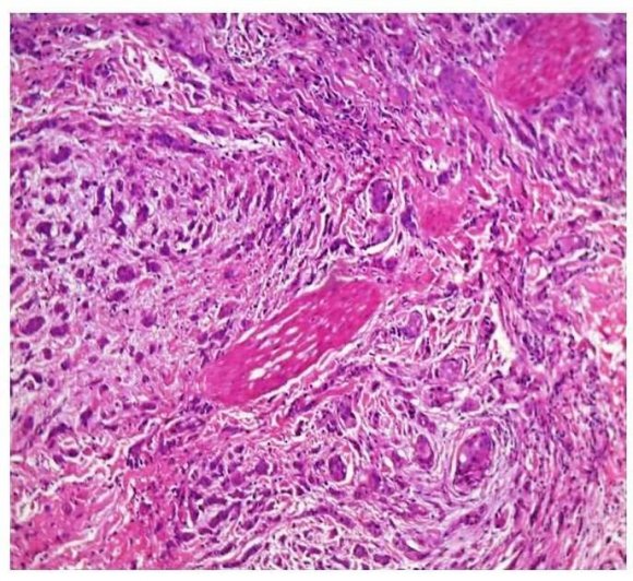 Fig. 5: Histogram showing prognostic parameters vs CK5/6 positivity IV.
