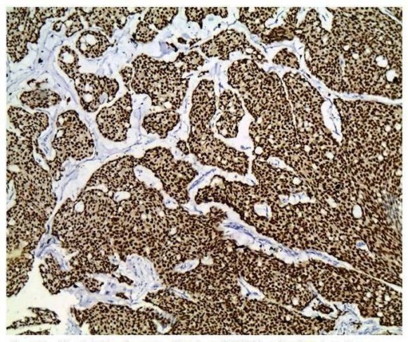Fig. 8: < 10% cells showing staining with CK5/6 IHC marker, IHC 100 x
