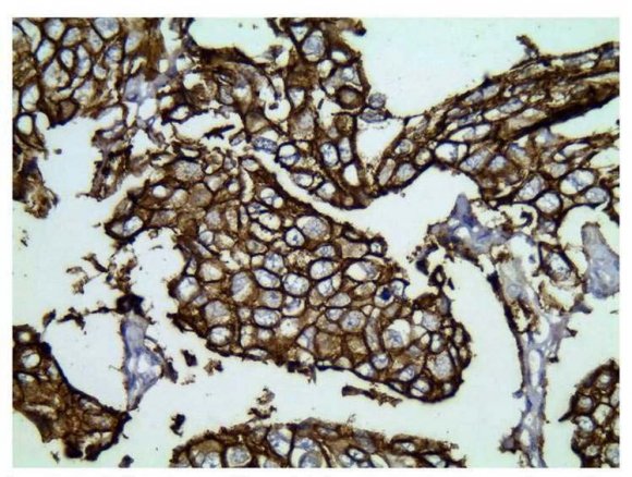 Fig. 9: > 50% cells showing staining with CK5/6 IHC marker, IHC 100 x