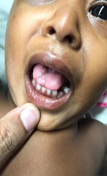 Fig. 1: Showing altered sensorium Fig. 2 & 3 Showing knuckle and periungual hyperpigmentation of both