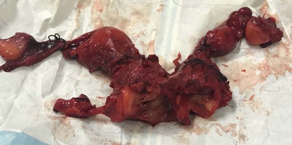 Fig.1: Cervical uterine cancer in the right cervix, with the scar of the cone, and parametrial resection. Atrophied uterine corpus left, cervix and vagina without tumor
