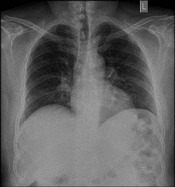 Figure 1: Chest X-Ray showing no air under the diaphagram