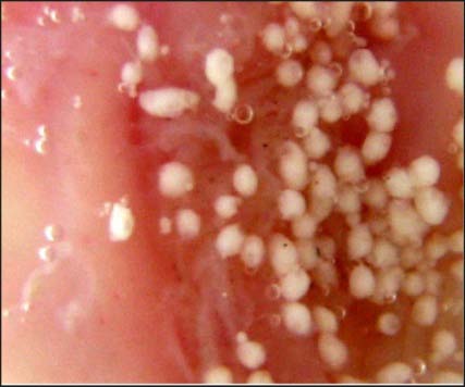 Figure 3: In-vitro wash-off test carried out on Hydralazine hydrochloride loaded Carbopol-934P mucoadhesive microspheres (batch F 4 ), using rat Mucosa after 8hrs