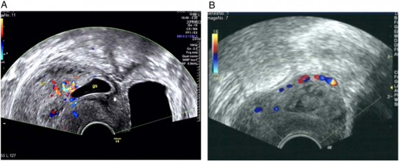 Fig. 1: Transvaginal ultrasonography images. (a) A 34-year-old woman with endogenous cesarean scar pregnancy t; a gestational sac is implanted at the site of a previous cesarean scar. (b) A 28-year-old woman with exogenous cesarean scar pregnancy type; the gestational sac implanted into a previous cesarean scar defect with outward growth that has infiltrated into the myometrium and bulges from the uterine serial surface. III.