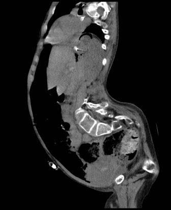 Photograph 1: Intraoperative photograph showing that the stomach was found not fixed to the anterior abdominal wall with about 5 cm of the tube between the stomach and the anterior abdominal wall with leakage of the methylene blue around the tube