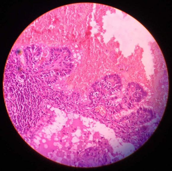 Fig. 2: FNAC smear under high magnification (40x) shows benign follicular cells arranged in clusters in a background of thin and thick colloid; suggestive of colloid goiter
