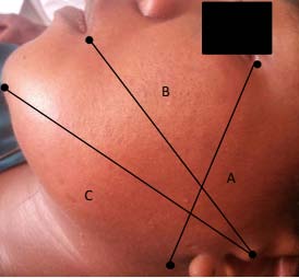 Figure 1: Measurement Method by Tape Measure A-The distance between the outer can thus and the gonion; B-Tragus and labial commissure; C-Tragus and coetaneous pogo ion.