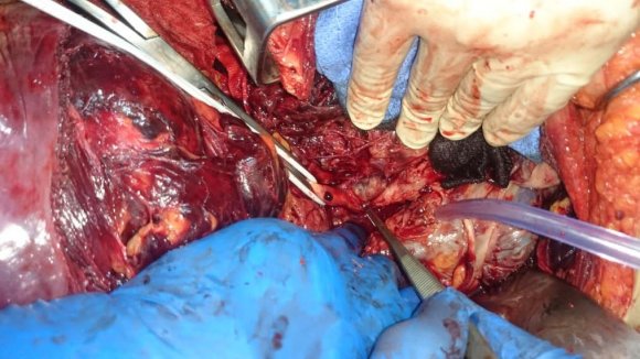 Fig. 3: Proximal Ulcer of the Aorta Performed with a Dacron-Patch (Arrow)