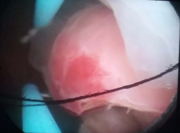 Figure 2: Gastric biopsy demonstrating fragments of gastric mucosa with mild chronic gastritis, focal ill-formed granulomas (arrow-head), and few giant cells (arrow)