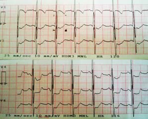 Fig. 4: Echo: M Mode in the LV Showed the Sever Dilatation and Poor Function