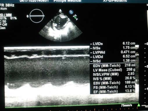Fig. 8: Echo: 6 Months Post-Surgery, Good Contractility