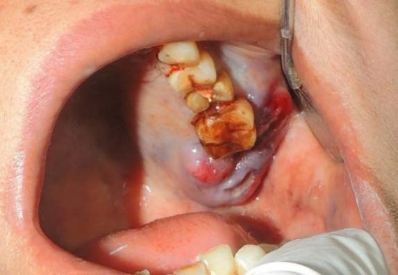 Fig. 2: Intra Oral View