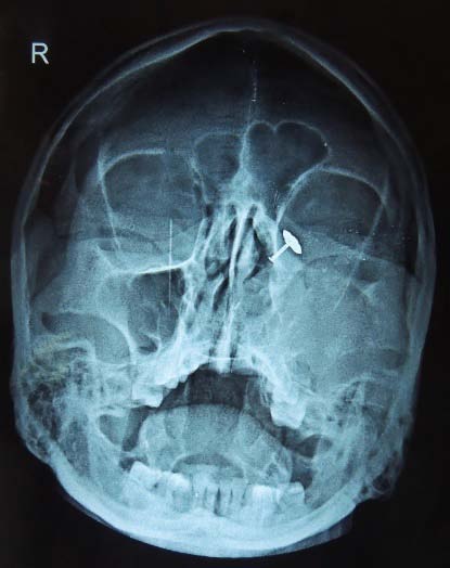 Fig. 7: Showing the Placement of Fascia Lata