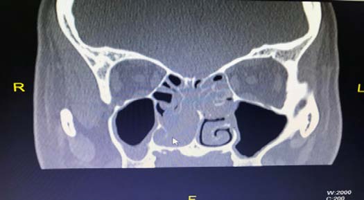 Fig. 1a and 1b: Computed Tomographic Scan of Nose and Paranasal Sinuses Showing Enhancing Soft Tissue Density Lesion along the Lateral Nasal Wall on the Right Side at the Region of Middle Meatus, Indenting the Medial Orbital Wall