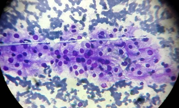 Fig.1: Cluster of cells with clear cytoplasm1