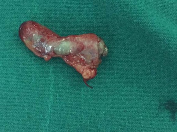Figure 2: Laparoscopic view of the impacted foreign body in rectum