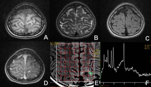 with adequate school performance, without signs of neurological focalization upon electroencephalographic study, without paroxysmal M discharges or significant asymmetries, for which reason pediatric neurology considers the progressive reduction of anticonvulsant dosages.