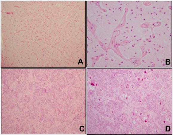 Figure 1: Cerebral image produced by magnetic resonance in which is observed, in the left parietal cortex, a hypo-intense lesion in T1, FLAIR (a, c), hyper-intense in T2 (b) enhanced by the administration of contrast (d). In a spectroscopic study of multiple voxel sequences (e) one can see heightened choline peak with a slight reduction of N-acetylaspartate and inverted lactate peak: in the single voxel sequence (f) is seen reduced N-acetylaspartate peak with increased myoinositol peak.