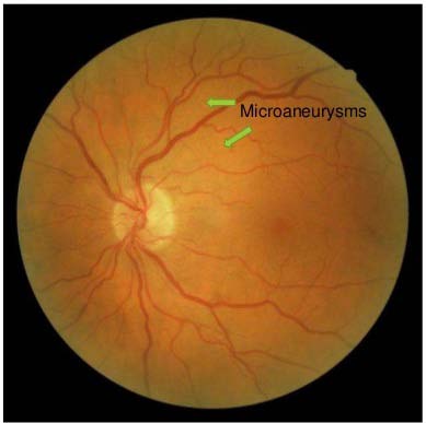 Microvascular complications divided into three totally different parts: ? Diabetic retinopathy ? Diabetic nephropathy ? Diabetic neuropathy III.