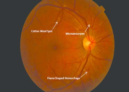 Figure 1: Mild non-proliferative retinopathy