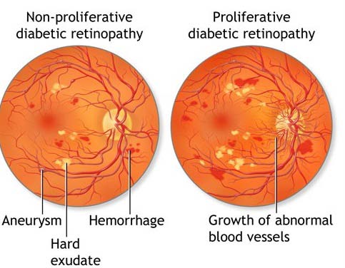 Figure 3: Several non-proliferative retinopathy
