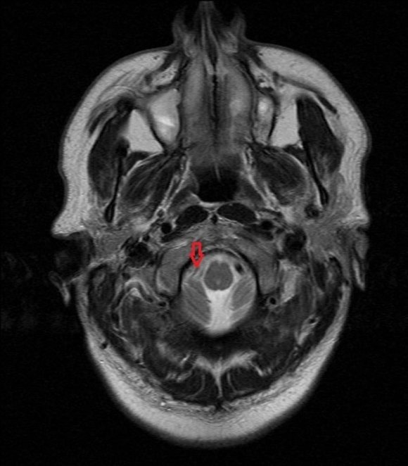 Fig. 3: T2 weighted images showing loss of right vertebral artery flow void.