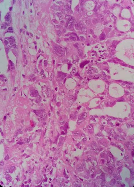 An eighty years old gravida 5 para 4 postmenopausal woman presented with continuous paraovarian malignancy. Diagnosis and management together with review of literature are discussed.