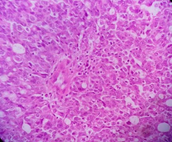 Fig. 1 and Fig. 2: High grade serous adenocarcinoma showing papillary structure with marked pleomorphism and frequent mitosis