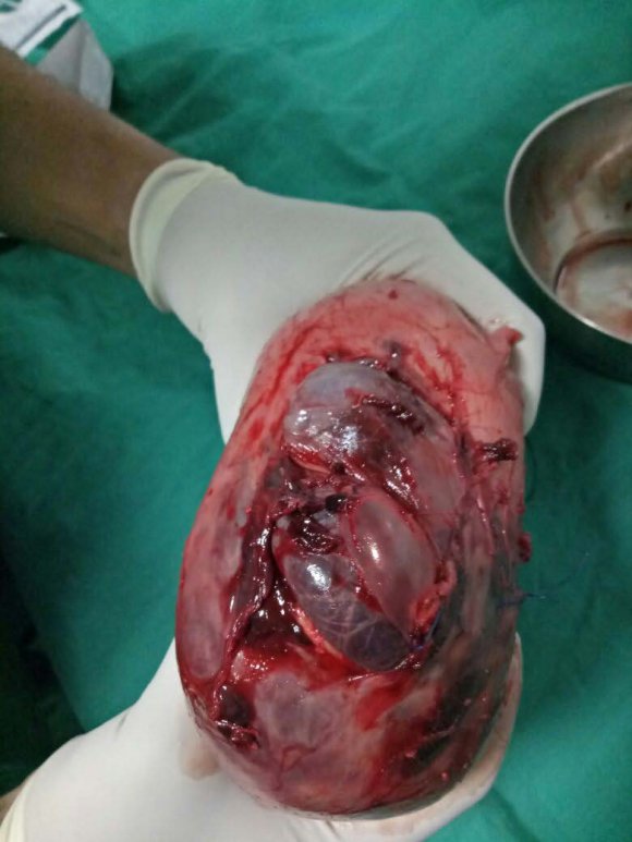 Figure 1: Post operative picture of uterus with the site of rupture marked with an arrow. III.