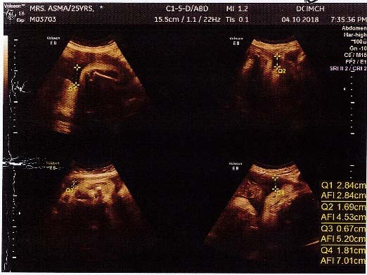 Figure 1: (a) shows USG of 31 weeks of full pregnancy, (b) and (c) at 33 weeks of pregnancy profile.
