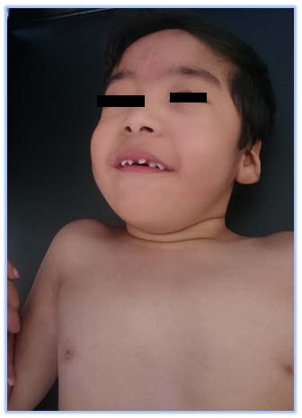Figure 1: Facial lesion type "Nevus flammeus", telecanthus, thick arched eyebrows, hypoplastic supraorbital ridges, depressed nasal bridge, anteverted nostrils and hypertelorism are observed