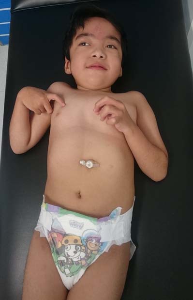 Figure 3: Ortho-radiography at 7 years of age, showing a scoliotic left lumbar curve with a scoliosis angle of 46 ° and a right dorsal compensatory curvature with a scoliosis angle of 34 °. On the lateral side there is an increase in the dorsal kyphosis at an angle of 63 °.