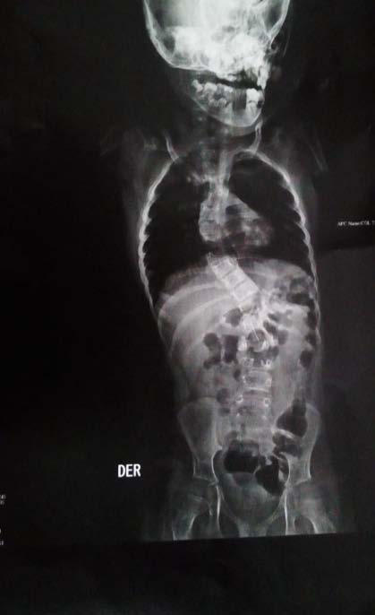 Bohring-Opitz Syndrome: First Latinoamerican Case and Review of the Literature