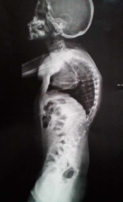 Figure 4: Congenital dislocation of ankles that hinders independent sitting and bipedestation.