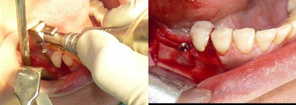 Work byHirano and colleagues has shown that the posterior glottis accounts for 50-65% area of the total glottis and Year 2019
