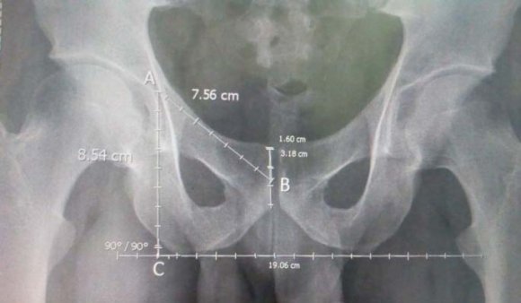 Figure 1: Measurement of pubic length (AB) and ischial length (AC) in male radiograph Statistical analysis was carried out with the help of SPSS version 16 and Microsoft Excel. The mean,standard deviation of pubic length, ischial length and ischiopubic index and corelation between pubic length,ischial length and ischiopubic index with the gender were expressed in tables and figures. III.