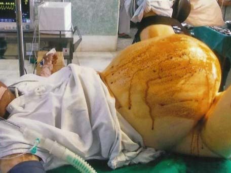 Doppler image Image 4: CT image of a benign Image 5: Uterus with cyst wall Image 6: Cyst wall Image 7: 6 litres fluid drained Image 8: Cyst wall, uterus with cervix, with an accessory horn Image 9: Abdomen after the cyst is deflated.