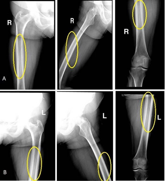 Figure 1: (a) Coronal MRI showing enhancement of lesion with contrast adhering to posterior tibial nerve (b) Axial MRI cuts showing enhancement of lesion with contrast (c) Sagittal MRI cuts showing enhancement of lesion with contrast adhering to flexor hallucis tendon