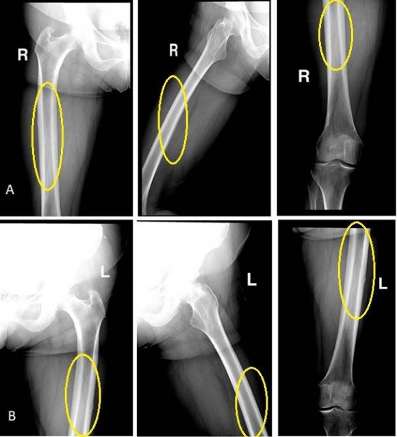 Figure 3 and 4: x-rays after closed reduction