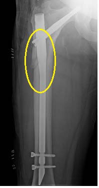 Figure 3: X rays of the right femur; A: week 3, B: week 6, C: week 12, D: week 15.