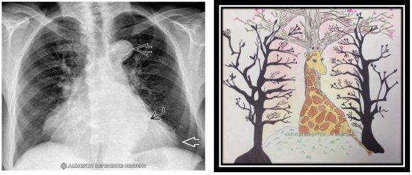 Figure 1: Chest x-ray Author: Resident of Radiology and Diagnostic Imaging U. sabana, Specialist / Master in Epidemiology U. Rosario/U. CES, Specialist in University Teaching U. Bosque, Cochrane researcher / AHA instructor UR, Professor, research, Rosario Univeristy, Areandina University. e-mail: wpradamancilla@gmail.com