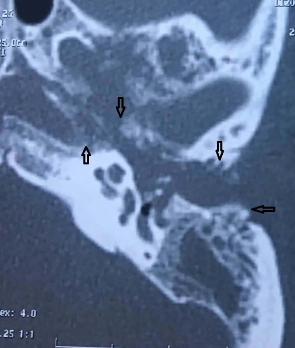 Figure 1: CT scan showing the collection in the left EAC, with osteolysis and osteitis of the temporal bone (Arrows).