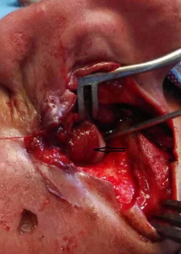 Figure 2: Per-operative view showing the tumor arising fronEAC (Arrow).