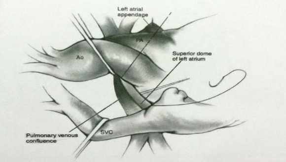 Figure 2: Schematic illustration of superior approach in 4-days old male with total anomalous pulmonary venous connection.
