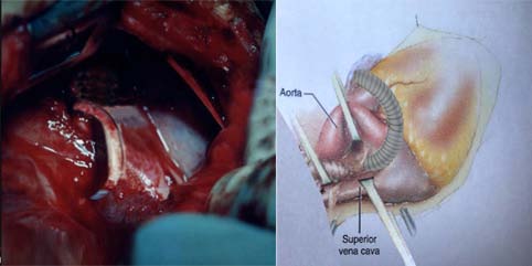 Figure 3: Schematic and operational photo illustrations of sarmast -takriti shunt (STS) in 4-days old male with total anomalous pulmonary venous connection.