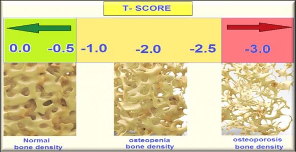 Figure A: Bone density in healthy and osteoporotic patients and related T-score values. For dual-energy X-ray absorptiometry (DEXA) technique, Bone densitometer DEXXUM3-Dragon -China has used for bone mineral density (BMD) measurements (g/cm 2 ) at the lumbar spine in L1-L4 vertebrae. The radiologists in fractures and joints department assessed the results. The T-score is the standard deviation above or below values for a 30-yearold healthy population. Participants were diagnosed with osteoporosis according to the World Health Organization (WHO) definitions that use T-score assessment, as shown in figure A. For blood sampling, over-night fasting blood samples volume of 5 ml were obtained by venipuncture and transferred to serum collecting tubes. Samples were allowed to clot for 20 mins at room temperature (20-30°C) then centrifuged at 3500x g for 10 mins. 25-OH-cholecalciferol in sera was determined by the ELISA method. The kit purchased from Bioassay-China and measured by Bioteks ELISA reader.17-?-estradiol was determined in serum using a competitive ELISA method with Streptavidin-Coated Plate following the instructions of the manufacturer Monobind Company-USA. Colorimetric assay with endpoint determination was used to measure serum Calcium levels. Arsenazo III reacts with Calcium in a slightly acidic solution to form a blue-purple complex that absorbs the light of wavelength at 650 nm, Intensity developed is proportional to the Calcium concentration. The endpoint determined by Auto Biochemistry Analyzer (AU240).
