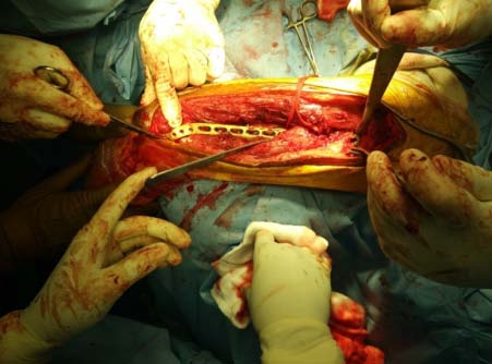 Evaluation of patients is done using the DASH and MAYO score and is categorized as: MAYO: Excellent 100-90; Good 75-89; Fair 60-74; Poor below 60. DASH: Excellent 0; Poor 100. The Pain was assessed using VAS score: No pain 0; Worst pain10.