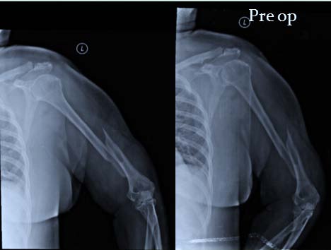 Outcomes of Lateral Column Plating in Extra-Articular Distal Humerus Fracture